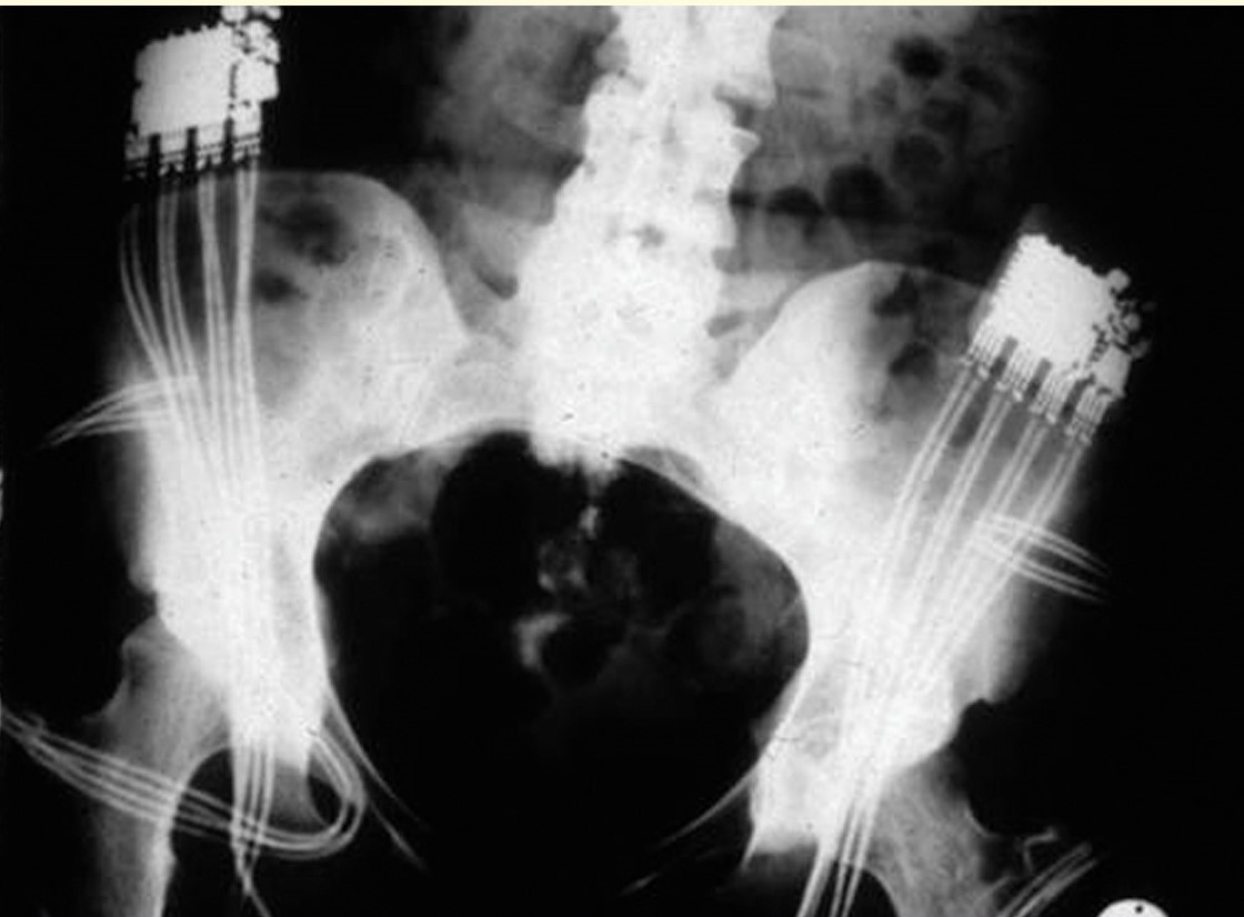 Röntgenaufnahme des Beckens mit Implantaten